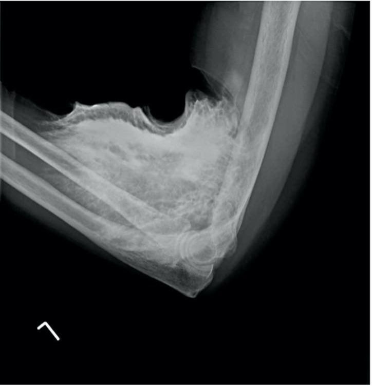 Iodinated Contrast Media Extravasation Injuries Should Osmolality and